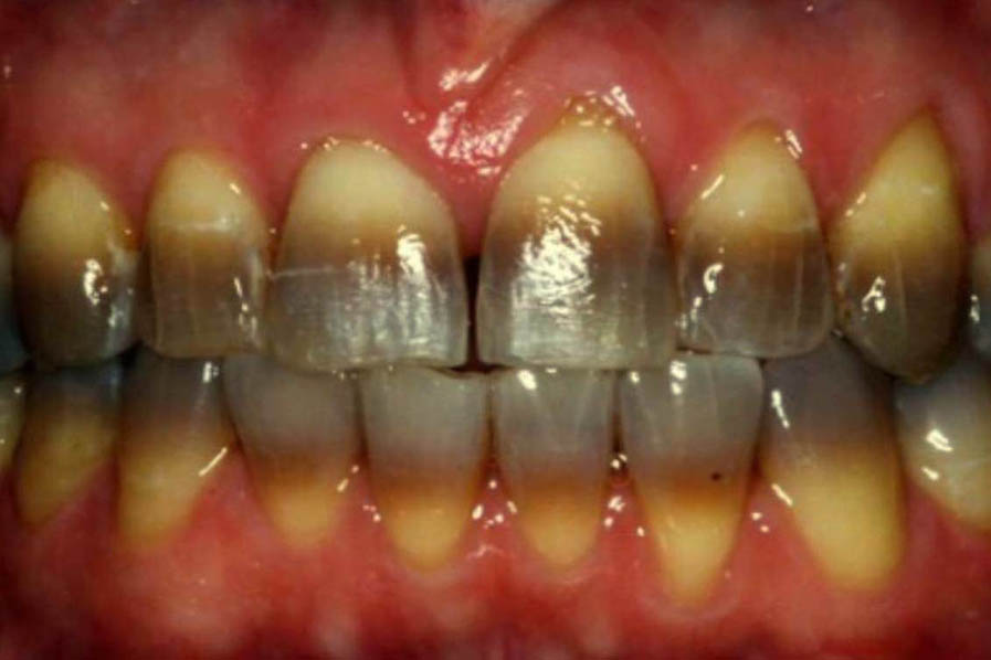TEETH WHITENING - Witkowski Dental