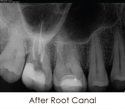 After-root-canal-2