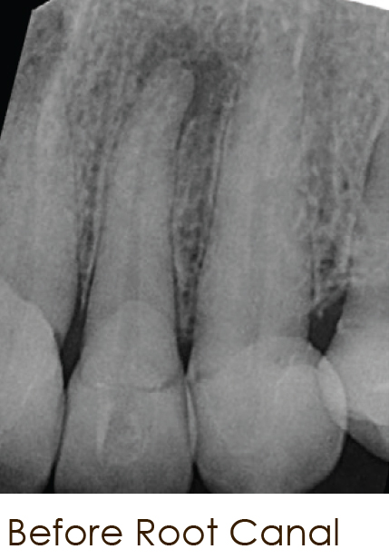 Before-root-canal