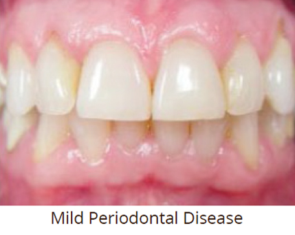 Mild-Periodontal-Disease