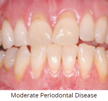 Moderate-Periodontal-Disease