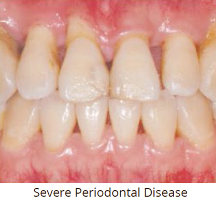 Severe-Periodontal-Disease
