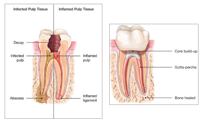 root-canal-illustration