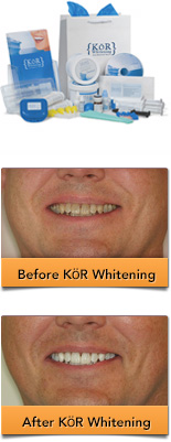 KöR Whitening Deep Bleaching System before and after